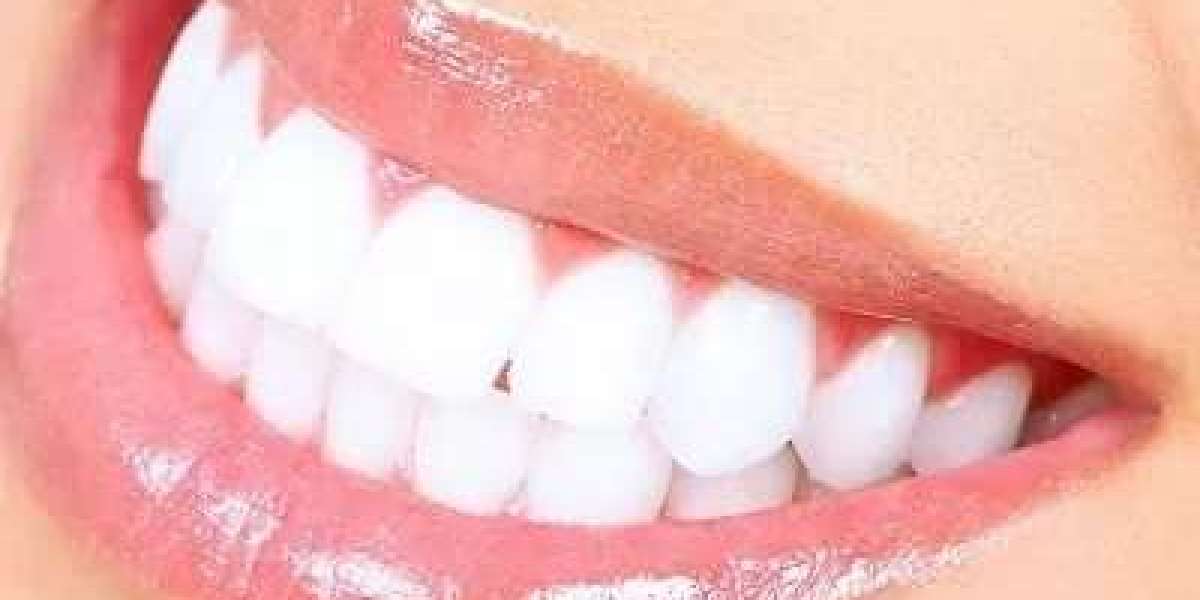 What Is the Downtime After Laser Teeth Whitening?