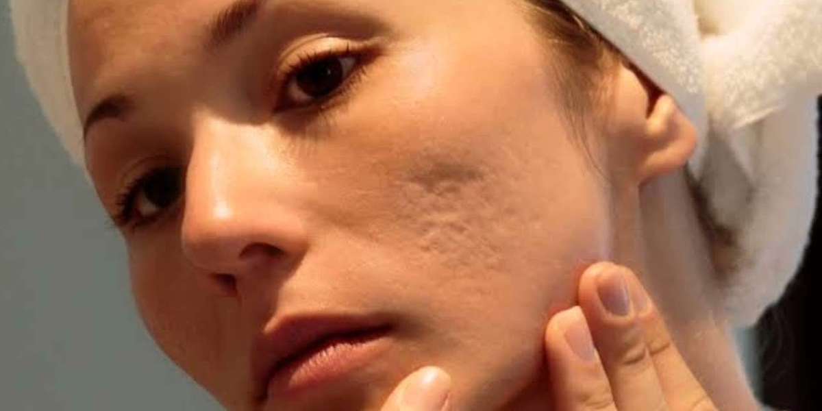 Laser Therapy for Acne Scars in Islamabad: Is It Worth It?