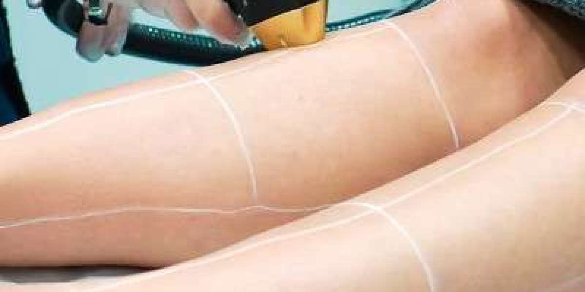 What Happens If You Miss a Session of Laser Hair Removal in Dubai?