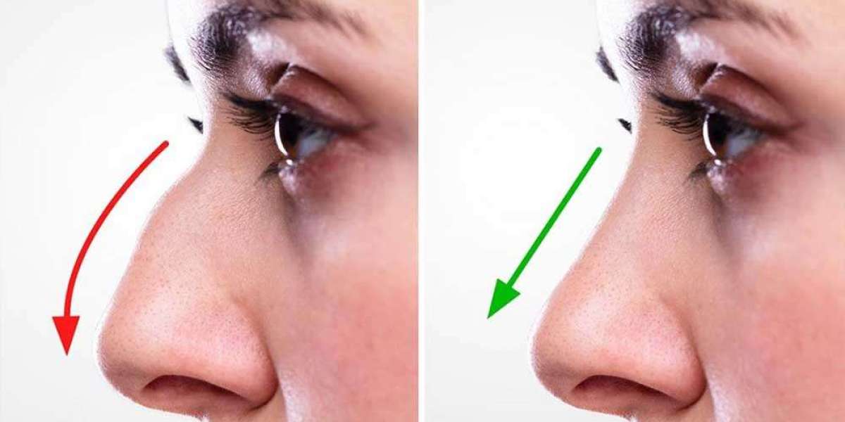 What Happens If I'm Unhappy With My Rhinoplasty Results in Dubai?