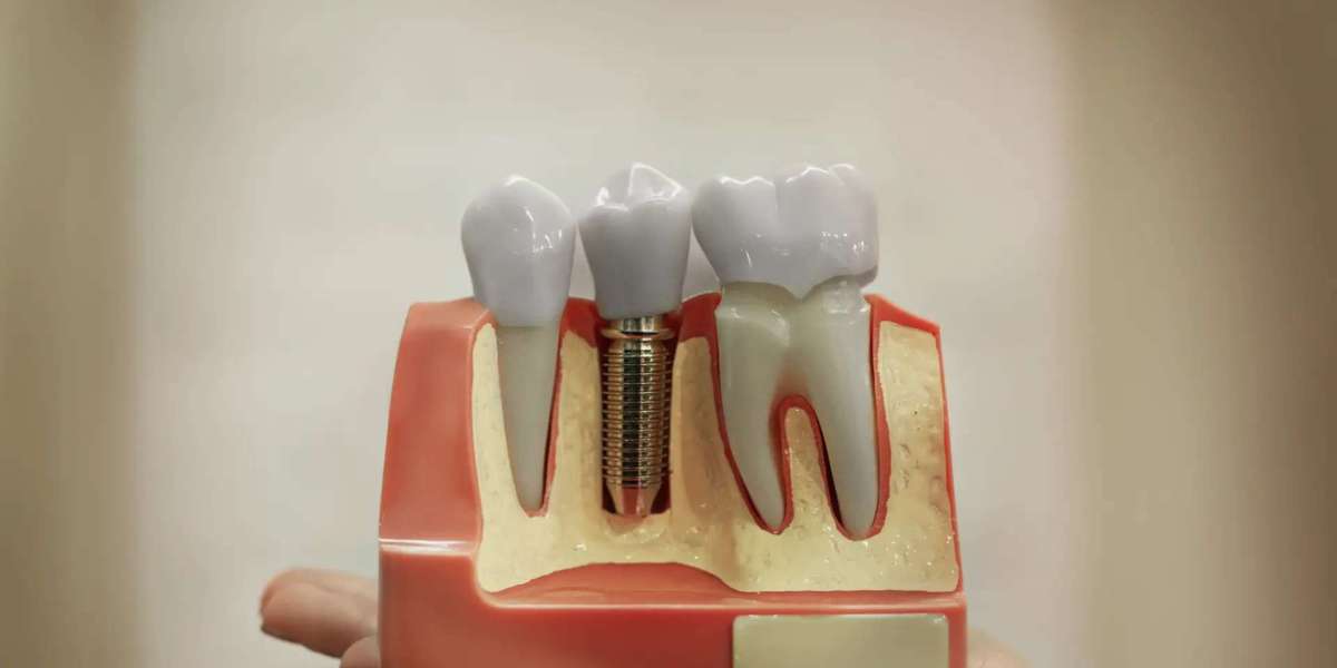 The Technology Behind Same-Day Dental Implants