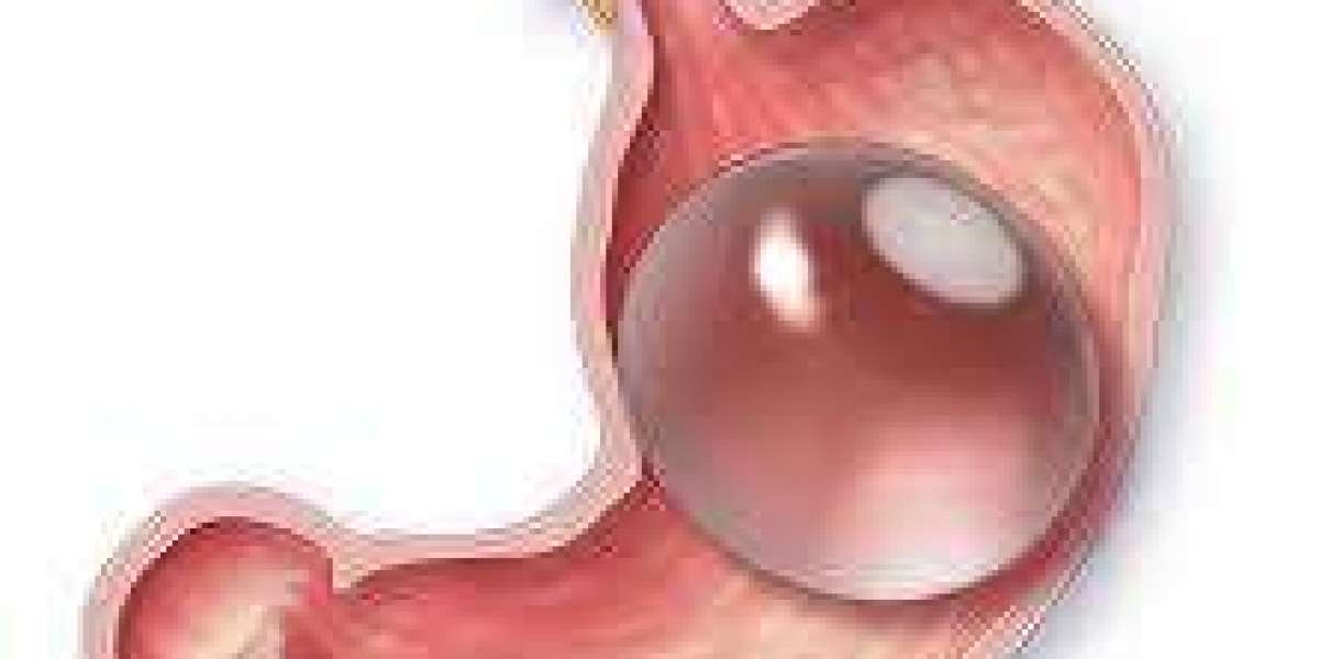 How Is a Gastric Balloon Inserted Without Surgery?