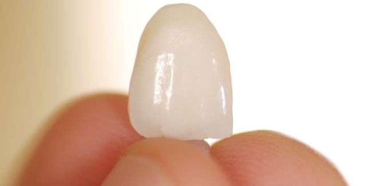 Can Non-Prep Veneers Be Removed? What You Need to Know