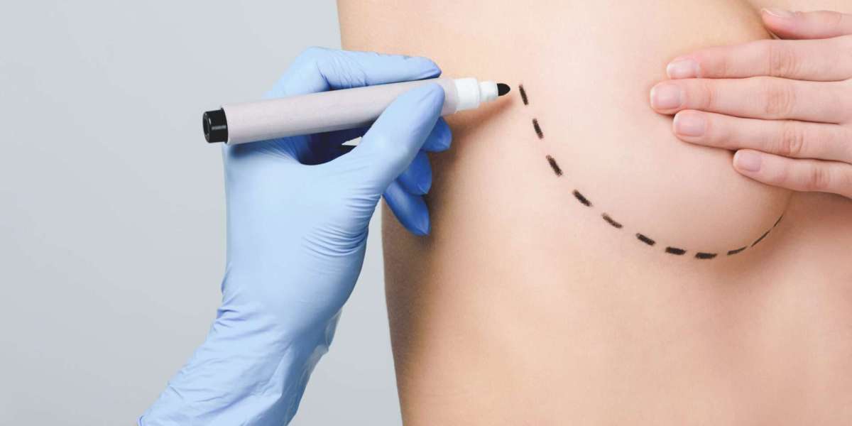 How Much Do Breast Implants Cost in Islamabad?