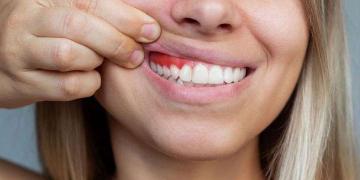 Gum Discoloration in Darker Skin Tones: What Are Your Options?