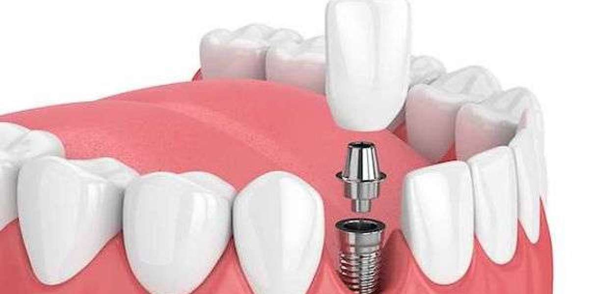 Will I Need a Sinus Lift for Dental Implants in Dubai?