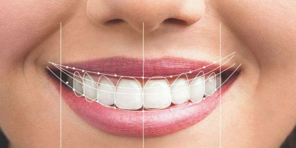 Digital Smile Design for Weddings: Perfect Smile in Time