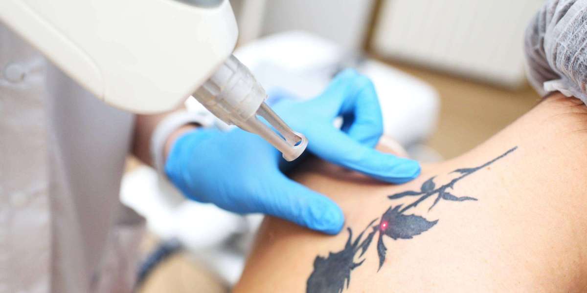 Understanding the Tattoo Removal Process: Step-by-Step Breakdown