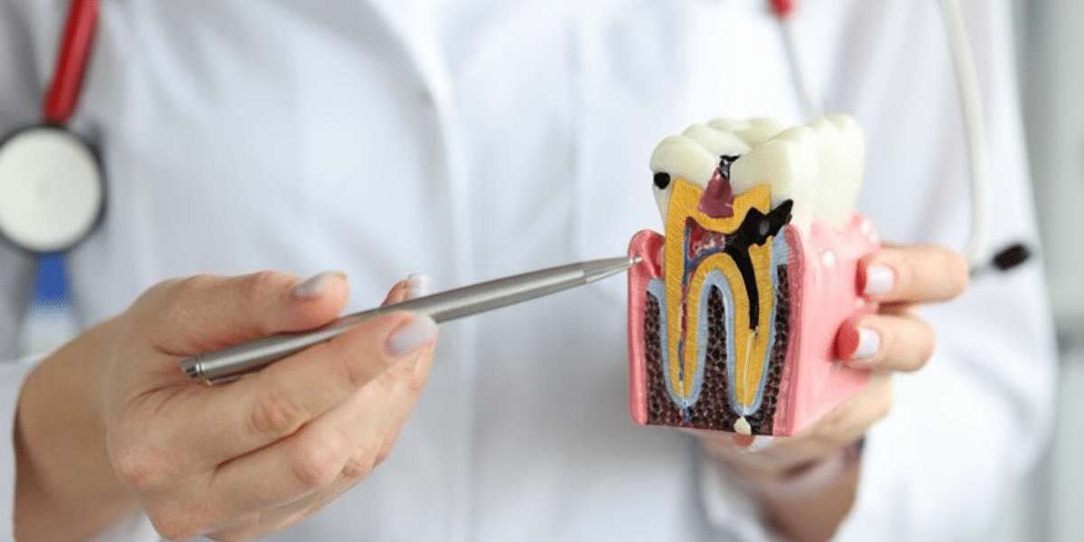 Crowns After Root Canal: When and Why You Need One