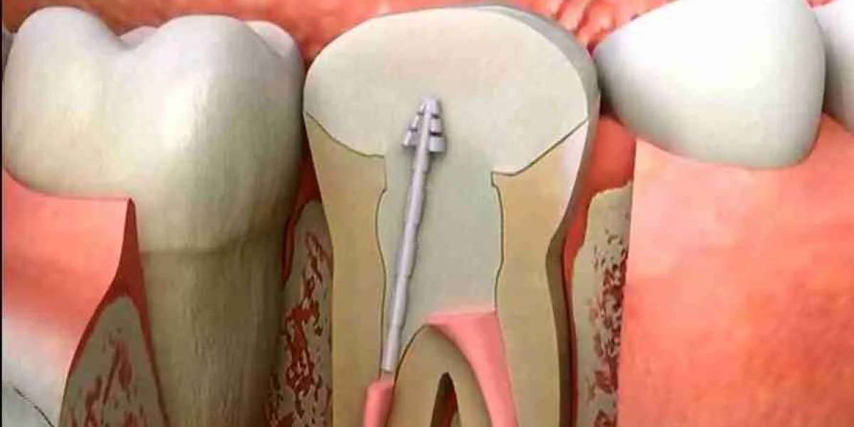 How Endodontists Differ from General Dentists in Root Canal Therapy