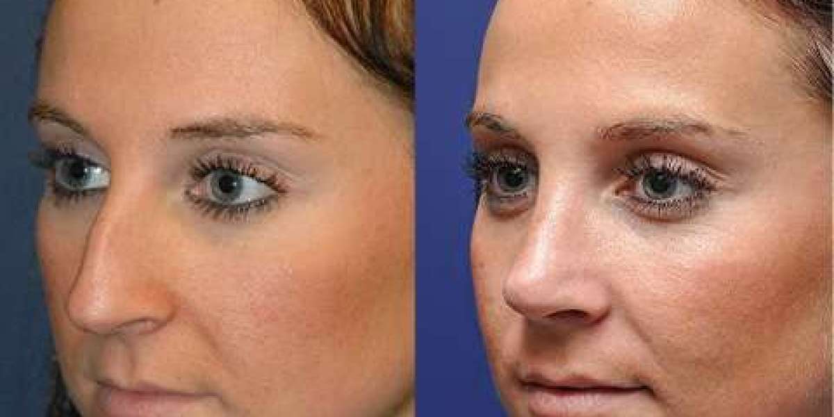 What Are the Most Common Complications from Rhinoplasty in Dubai?