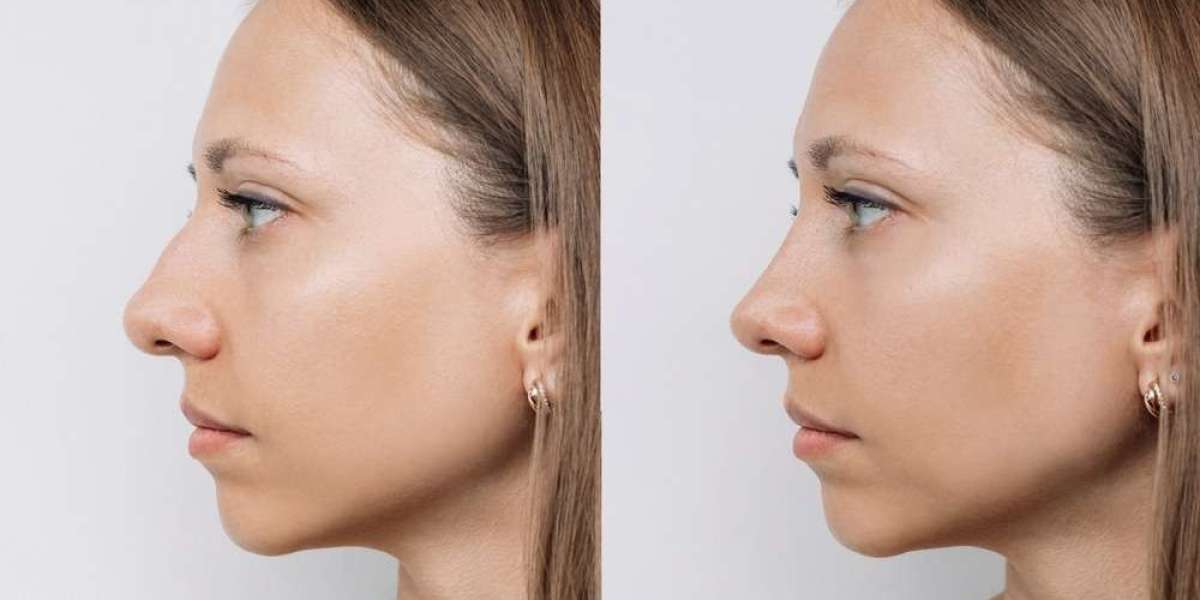 Will My Voice or Speech Be Affected After Rhinoplasty in Dubai?
