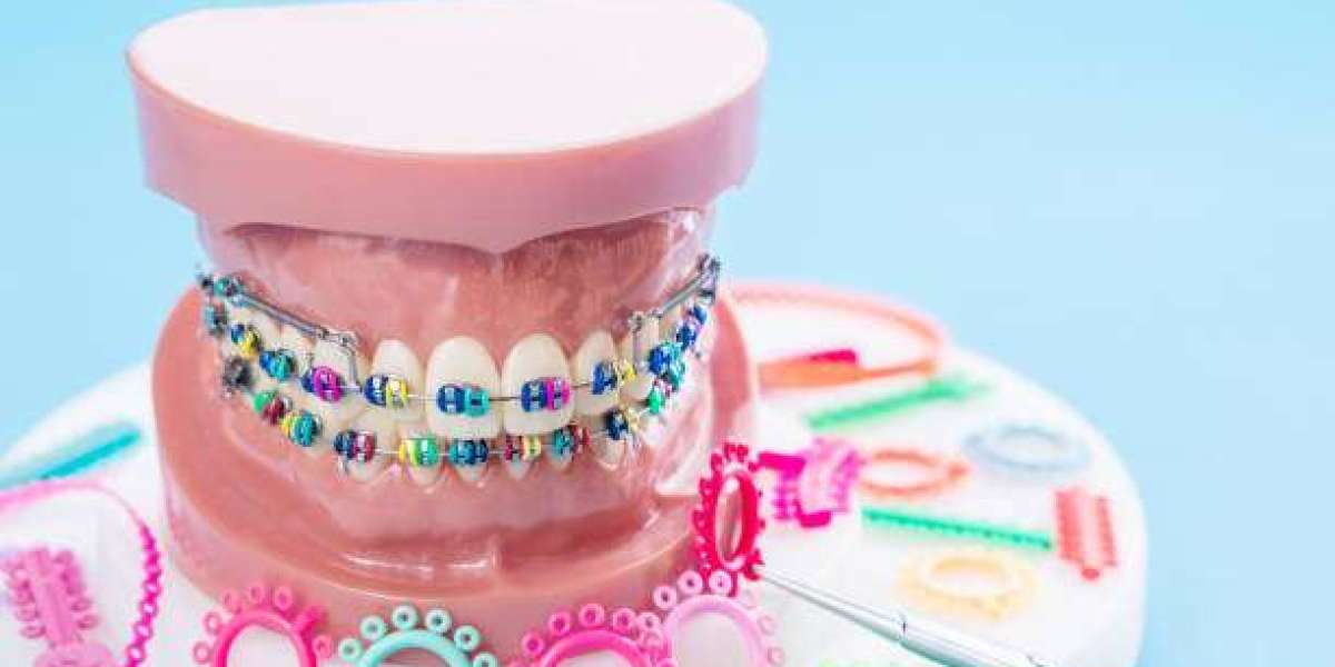 Can Dental Braces Fix Gaps in Your Teeth?