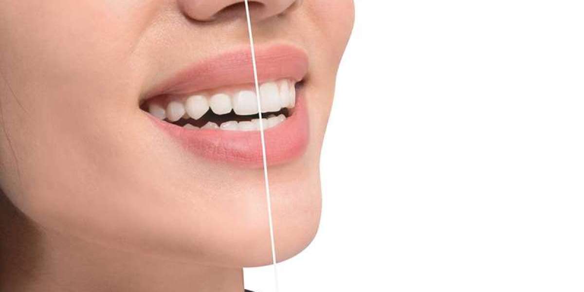 Combining Gum Contouring with Teeth Whitening: The Perfect Smile Duo