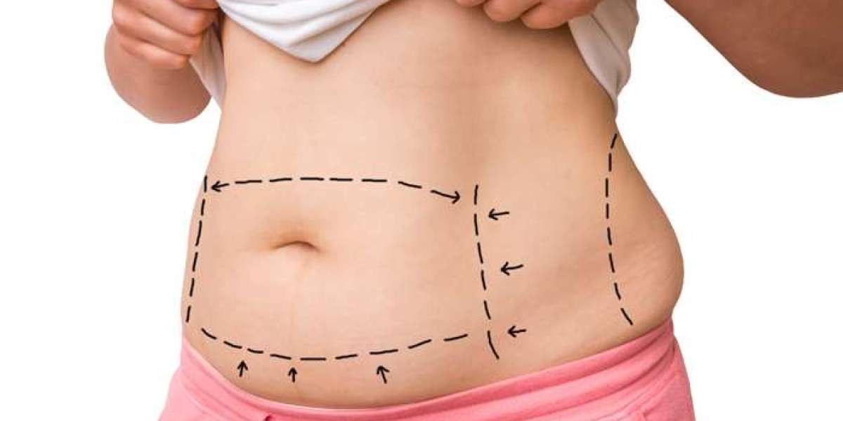 Are There Any Non-Surgical Alternatives to Abdominal Liposuction in Dubai?