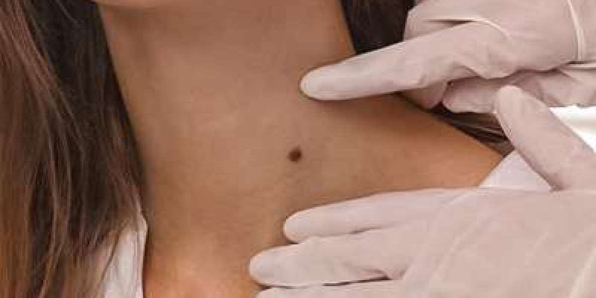 Removing Moles for a Smoother Skin Tone