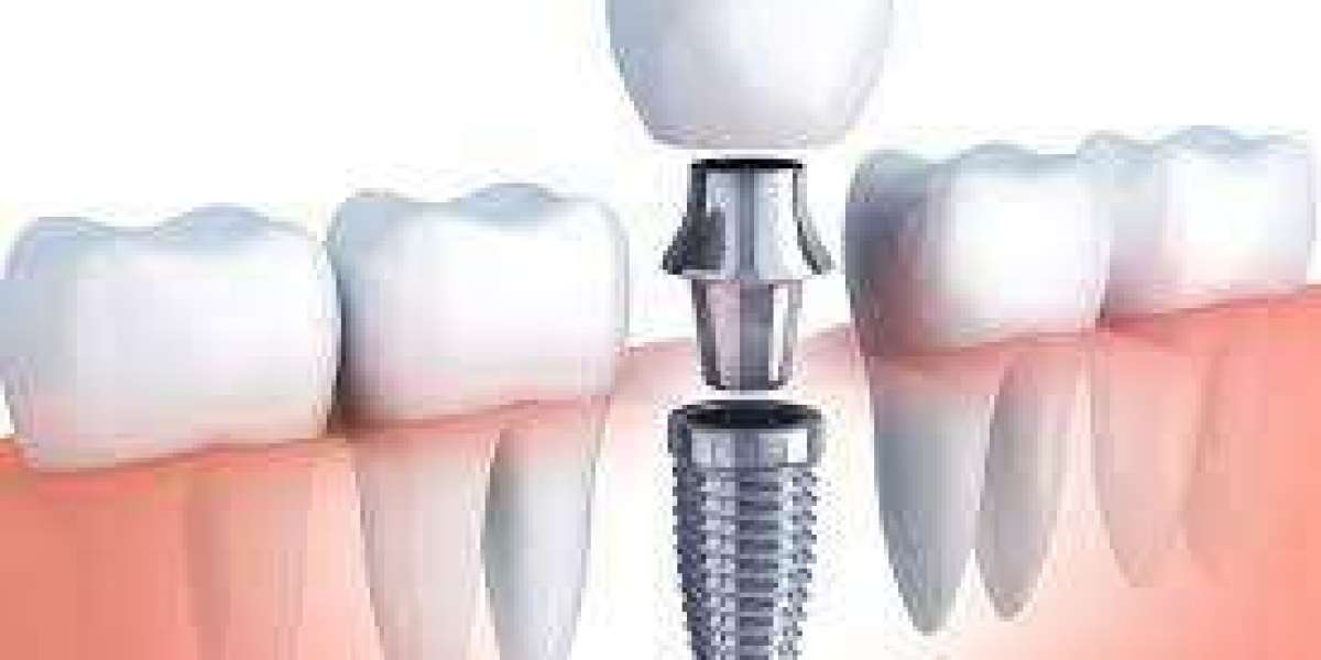 What Should I Do If I Experience Pain Months After My Dubai Implant Surgery?
