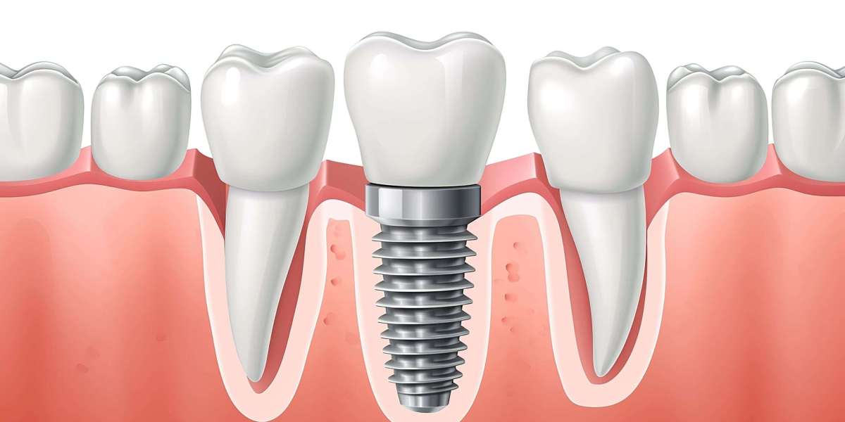 Dental Implants for Seniors: Are They Safe and Effective?
