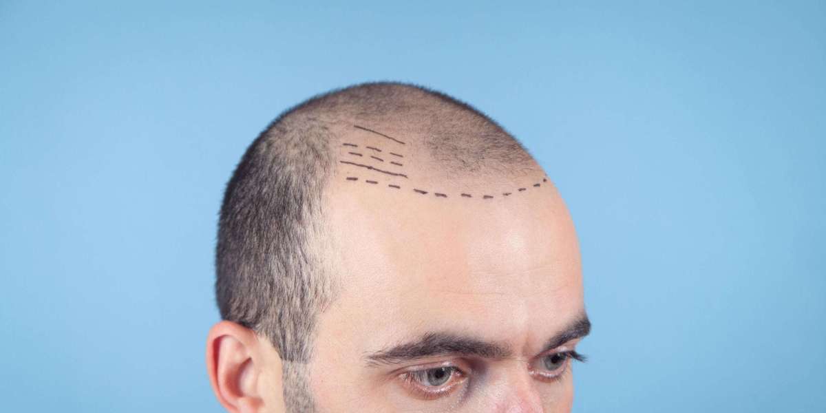 What Happens if Your Hair Transplant Fails? Next Steps Explained