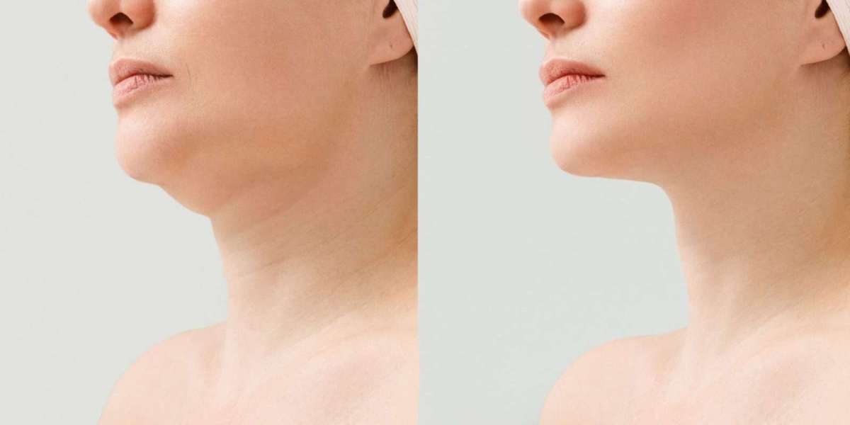 Who Is the Ideal Candidate for Double Chin Removal in Islamabad?