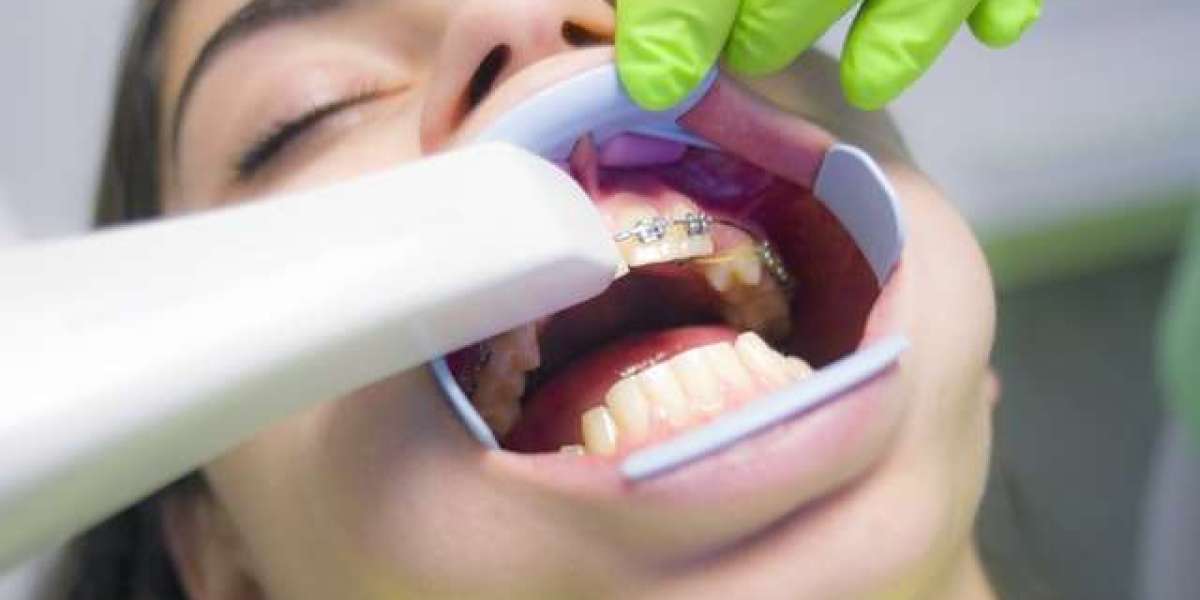 What to Expect When Wearing Your First Dental Appliance