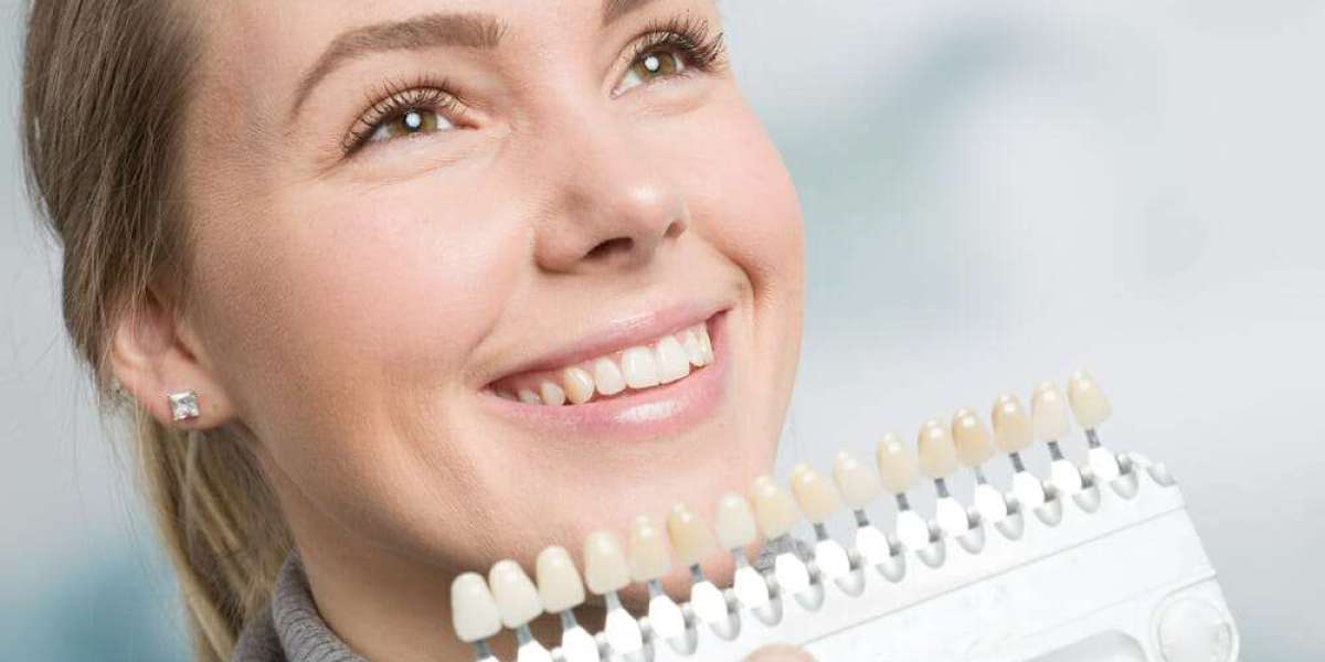 Can Teens Get Composite Veneers? Age and Eligibility