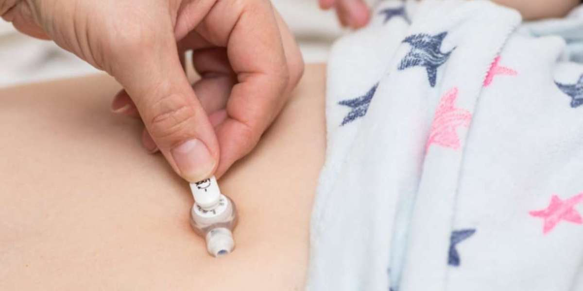 Tube Feeding After Surgery: Recovery and Nutrition