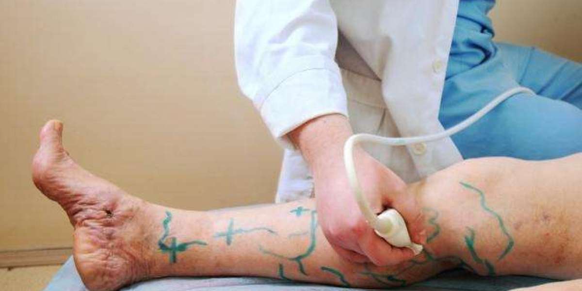 The Best Skincare Routine to Support Spider Veins Healing