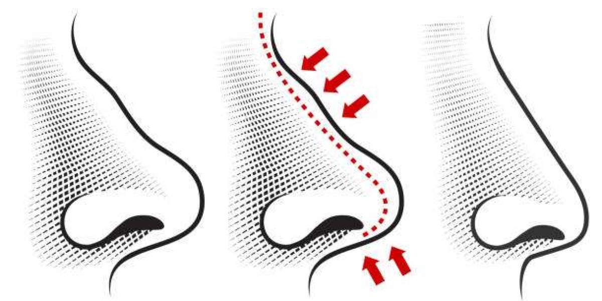Functional Rhinoplasty in Islamabad – Improve Breathing & Appearance
