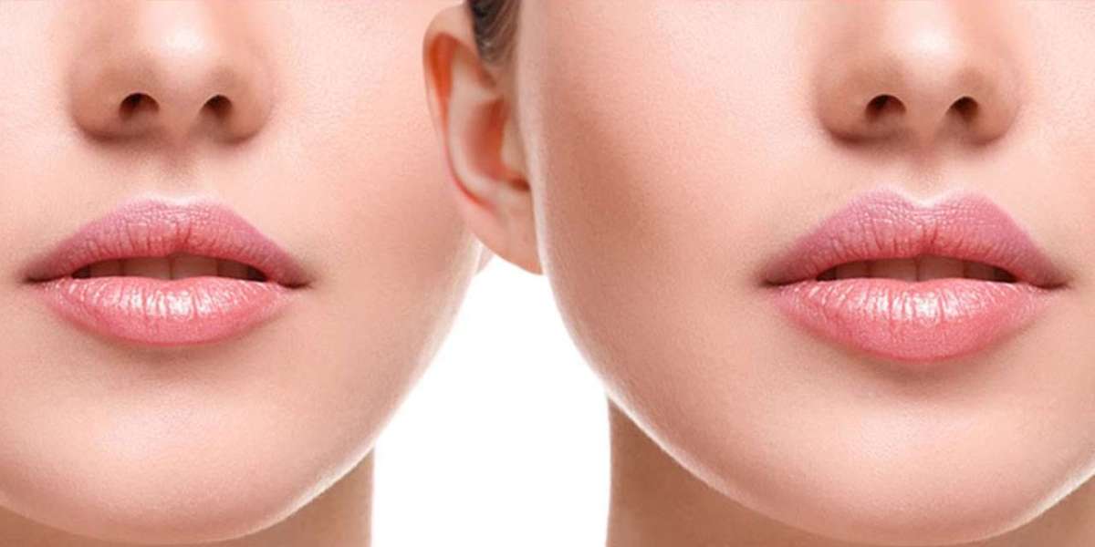 Lip Reshaping for Asymmetry: Islamabad Solutions