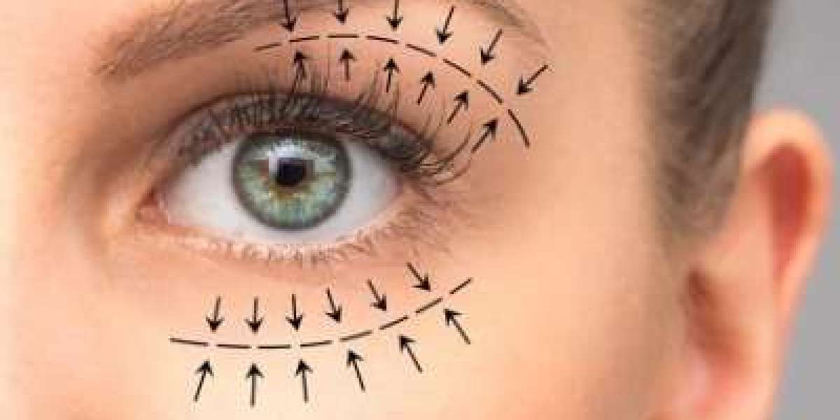 Eyelid Surgery in Islamabad: Aesthetic Renewal That Respects Your Identity