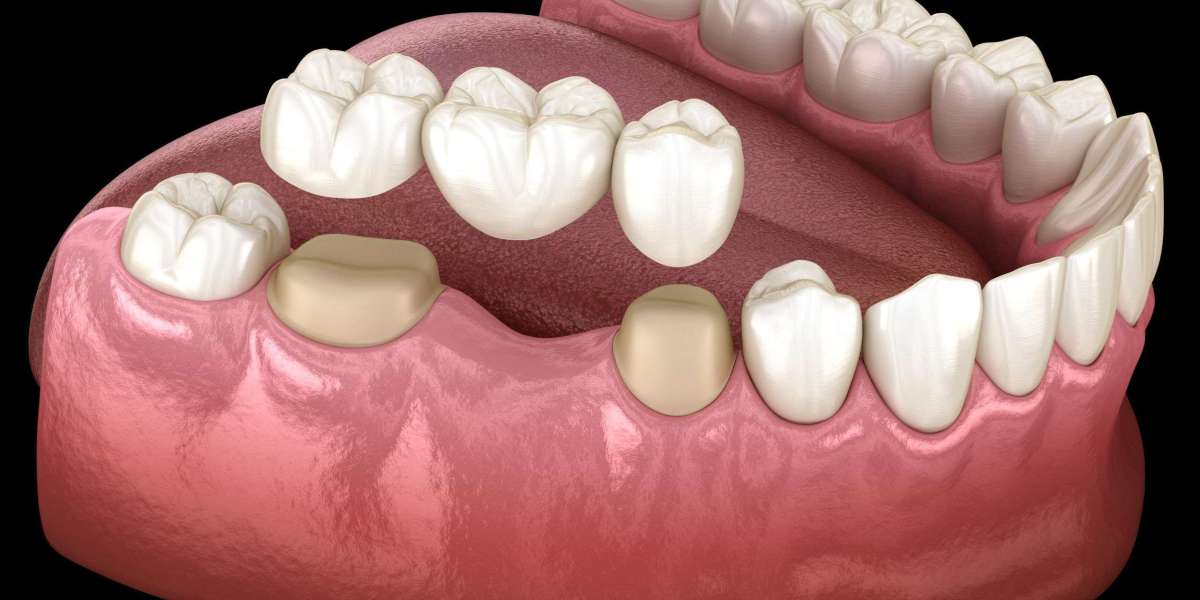 Enjoy Pain-Free Chewing with Dental Crowns