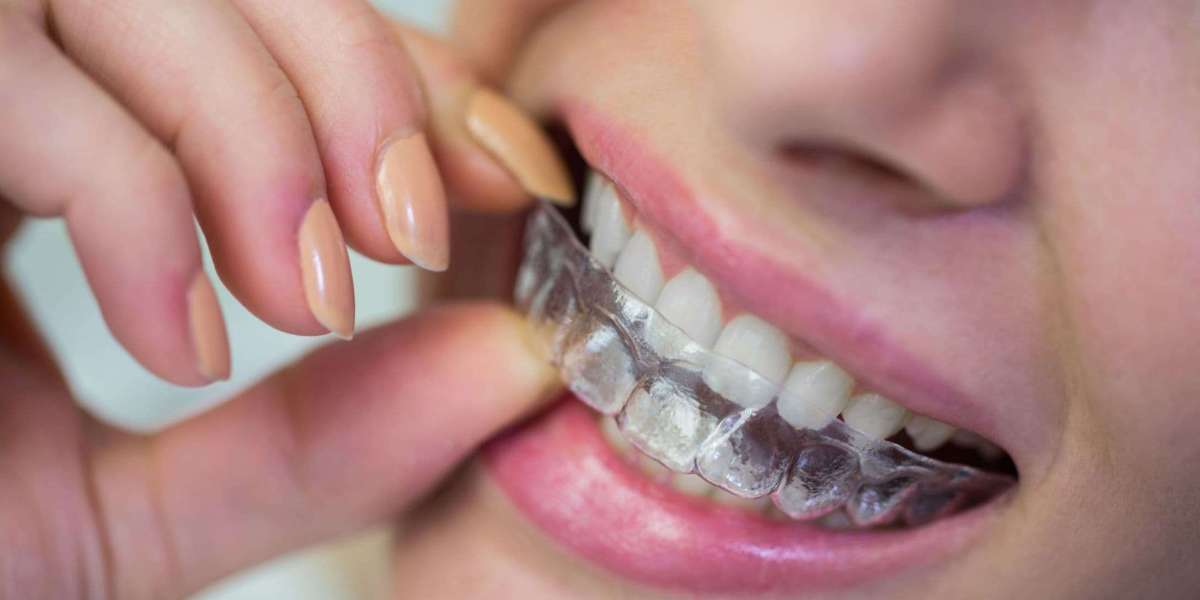 How to Avoid Losing Your Dental Retainer: Practical Advice