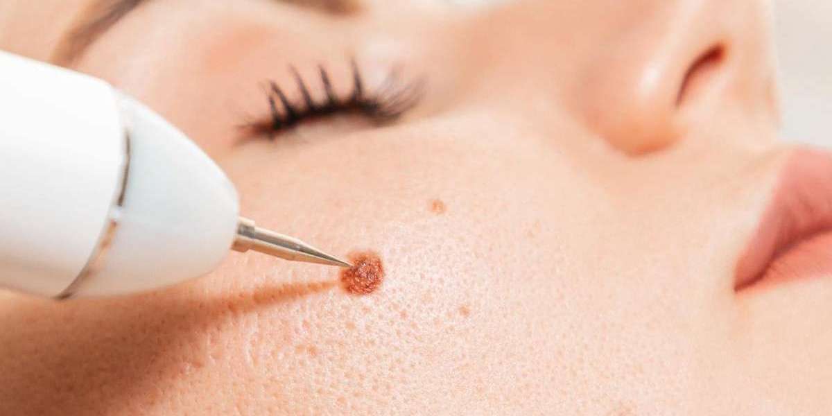 Treating Common Warts in Islamabad
