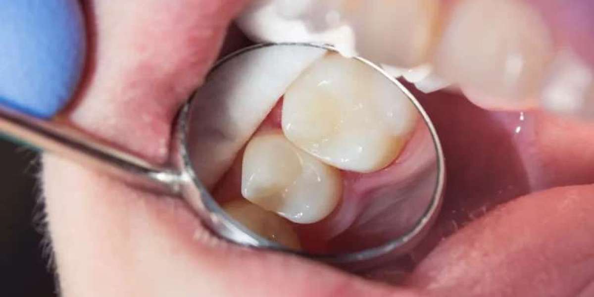 Are Tooth Fillings Painful? Separating Myth from Reality