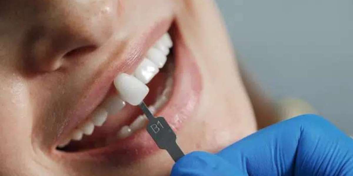The Pros and Cons of Composite Veneers