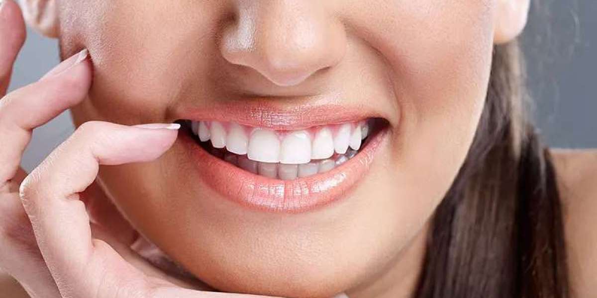 Are E-max Veneers Painful? What to Know About the Procedure