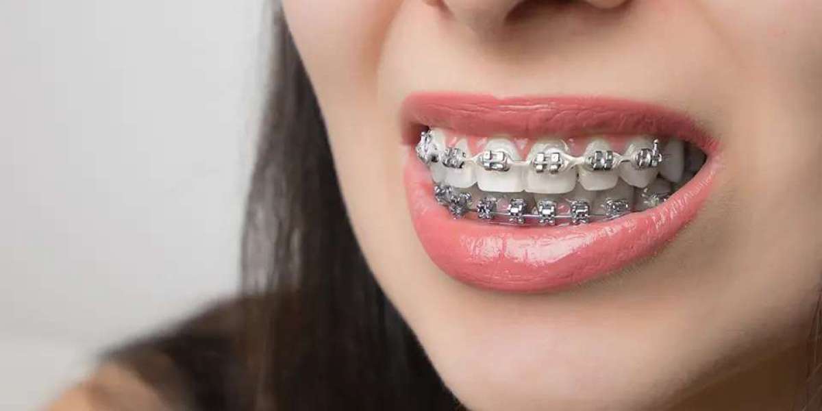 Top Dental Tools to Make Life with Metal Braces Easier