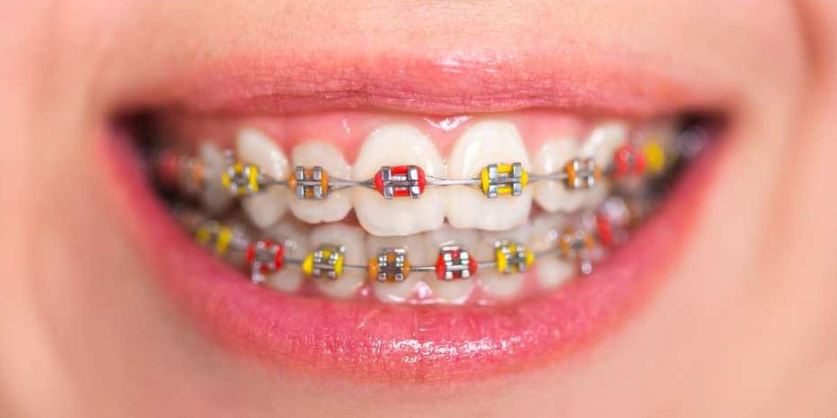 How to Maintain Oral Hygiene With Dental Braces: Step-by-Step