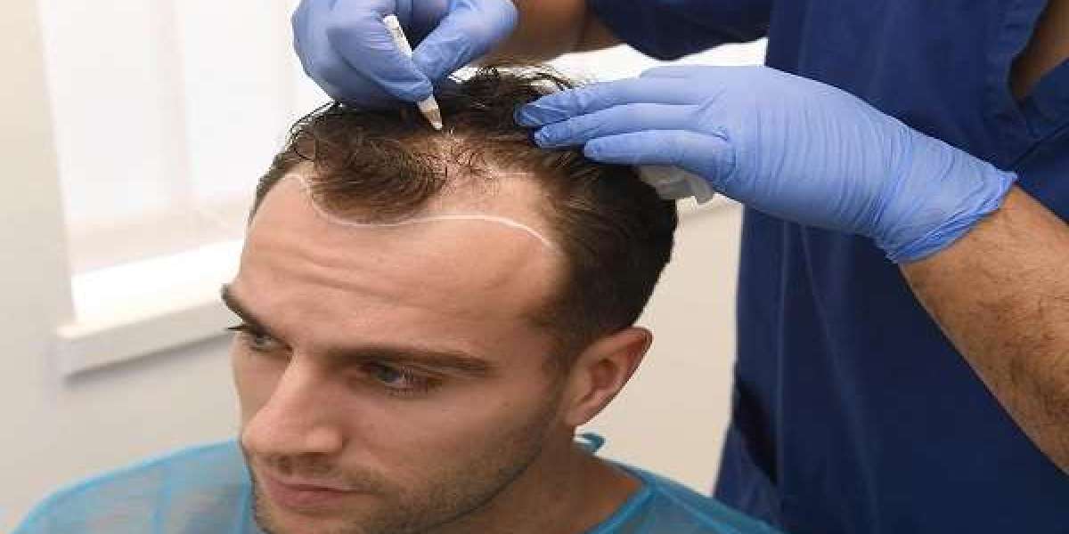 Hair Transplant for Men in Islamabad