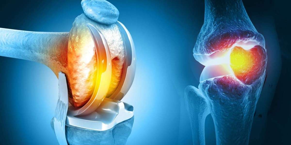 Factors to Consider Before Choosing Knee Replacement