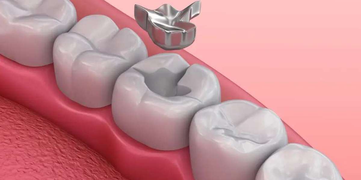 The Environmental Impact of Amalgam Tooth Fillings