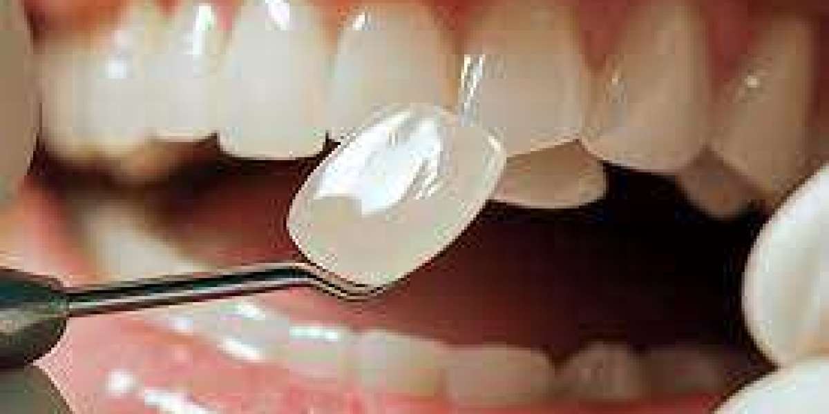 Composite Veneers for Teens and Young Adults: Is It Safe?