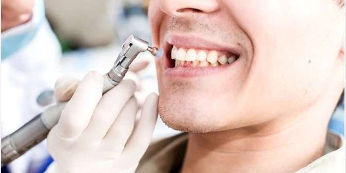 Can Teeth Polishing Remove Deep Stains? Expert Insights