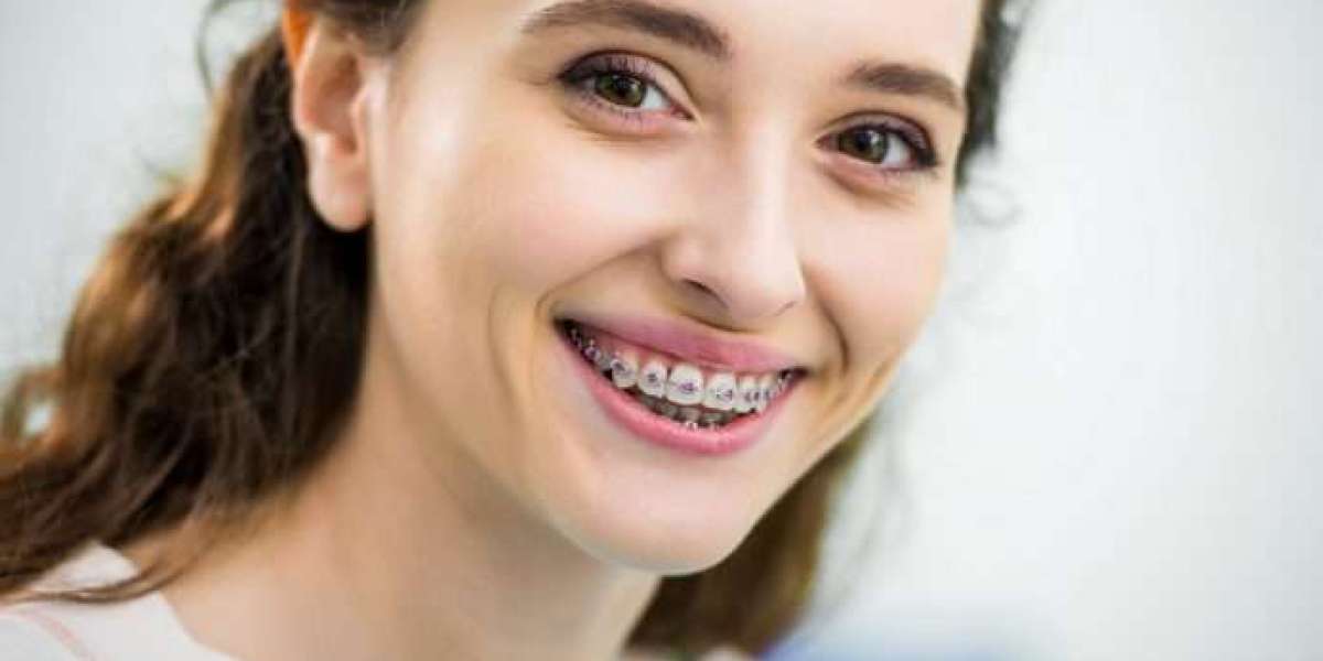 What Happens After Braces? A Look at Retainers and Results