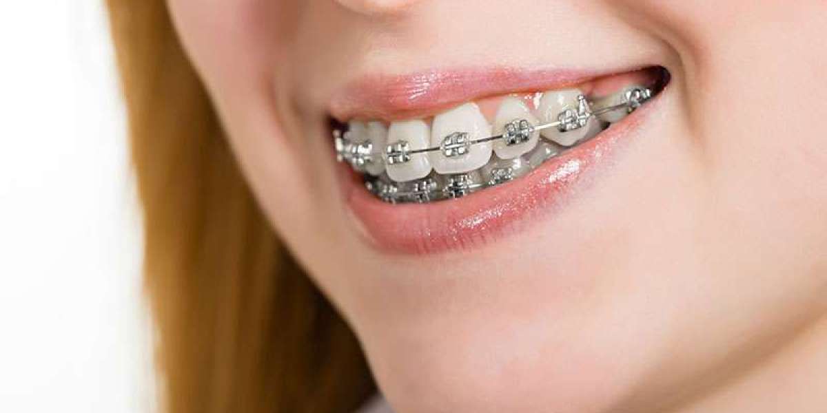 How Often Should You Replace Your Dental Retainer?