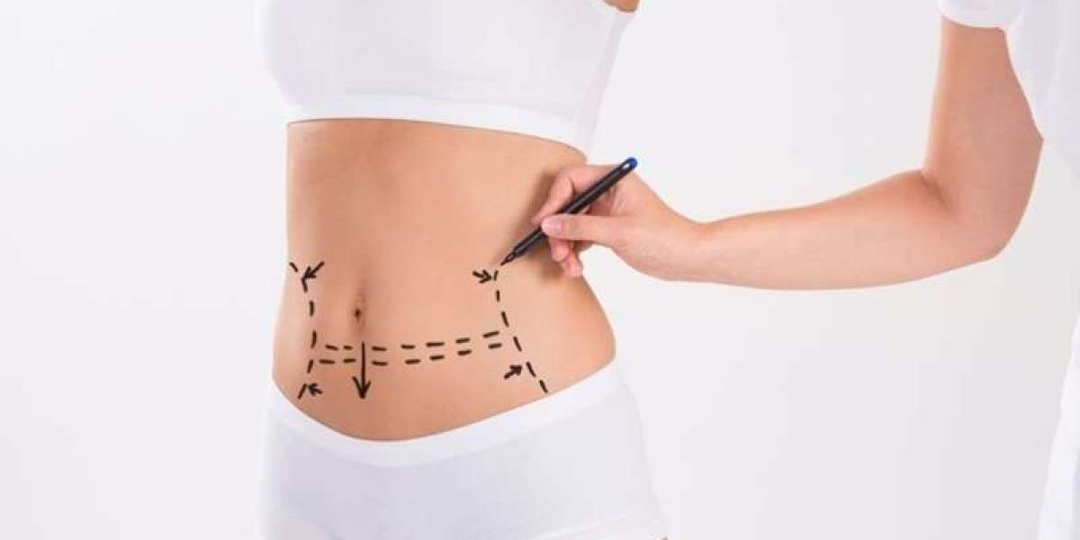 How to Save Money on Your Tummy Tuck in Islamabad