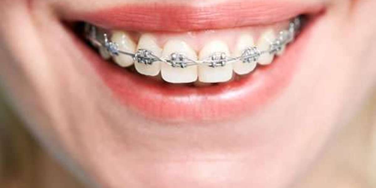 Metal Braces for Teens: What Parents Should Know