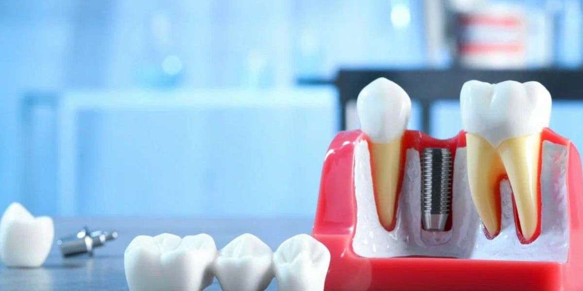 10 Questions to Ask Before Getting Dental Implants