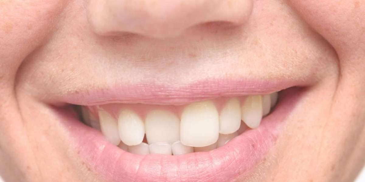 The Connection Between Overlapping Teeth and TMJ Disorders